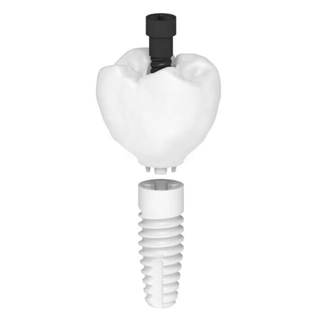 Keramikimplantat Keramikimplantat